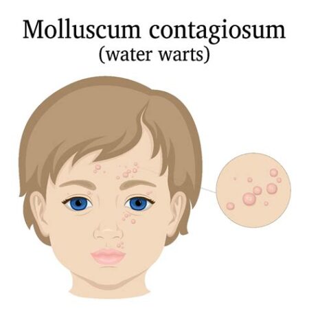 Molluscum Contagiosum: Belirtileri, Tedavisi, Korunma